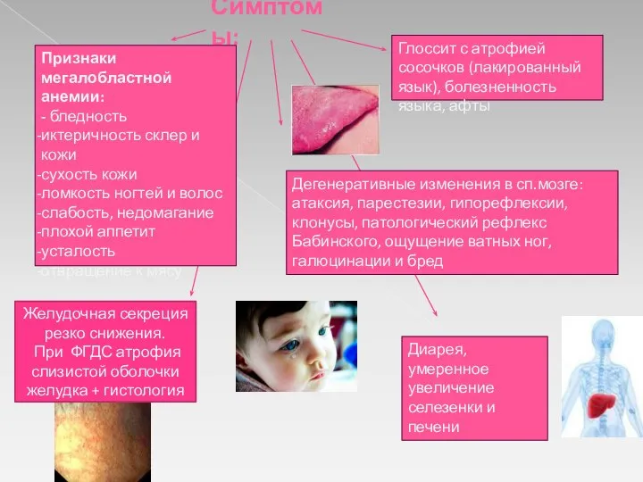 Симптомы: Признаки мегалобластной анемии: - бледность иктеричность склер и кожи сухость