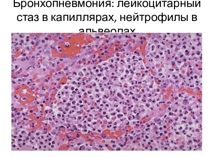 Бронхопневмония: лейкоцитарный стаз в капиллярах, нейтрофилы в альвеолах