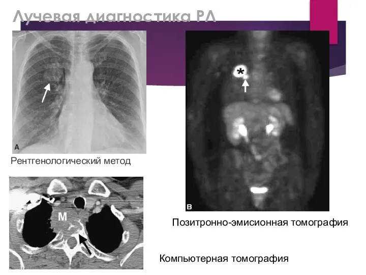 Лучевая диагностика РЛ Рентгенологический метод Позитронно-эмисионная томография Компьютерная томография