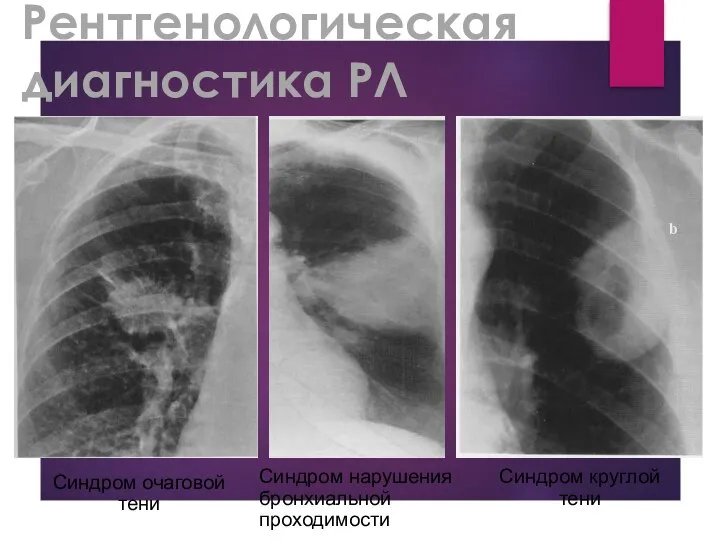 Рентгенологическая диагностика РЛ Синдром нарушения бронхиальной проходимости Синдром круглой тени Синдром очаговой тени