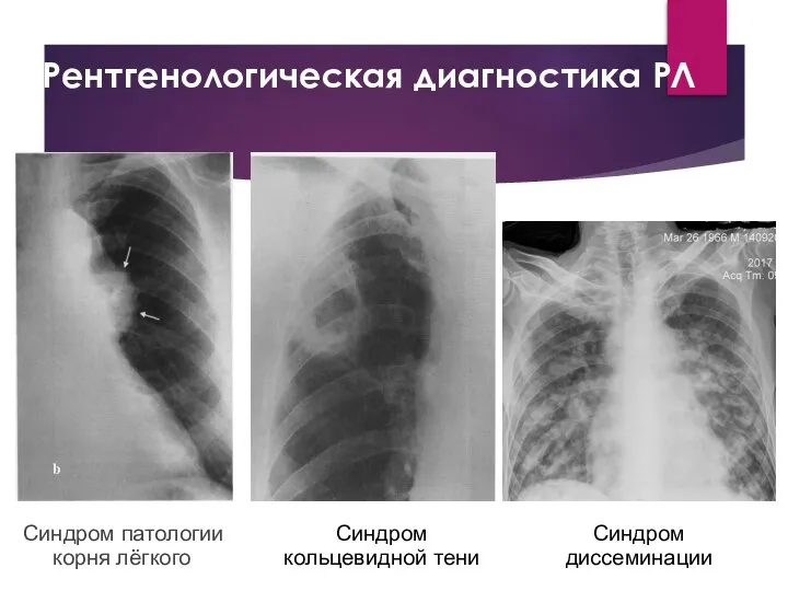 Рентгенологическая диагностика РЛ Синдром патологии корня лёгкого Синдром кольцевидной тени Синдром диссеминации