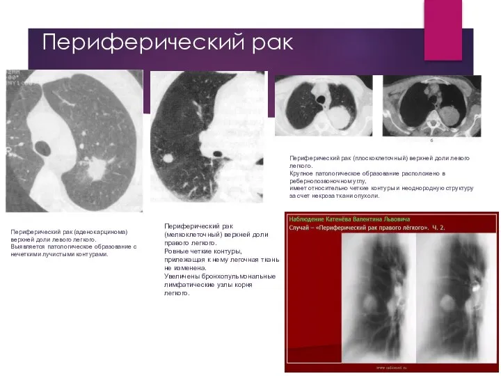 Периферический рак Периферический рак (аденокарцинома) верхней доли левого легкого. Выявляется патологическое