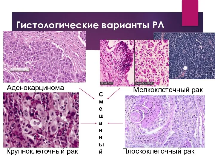 Гистологические варианты РЛ Аденокарцинома Плоскоклеточный рак Крупноклеточный рак Мелкоклеточный рак Смешанный