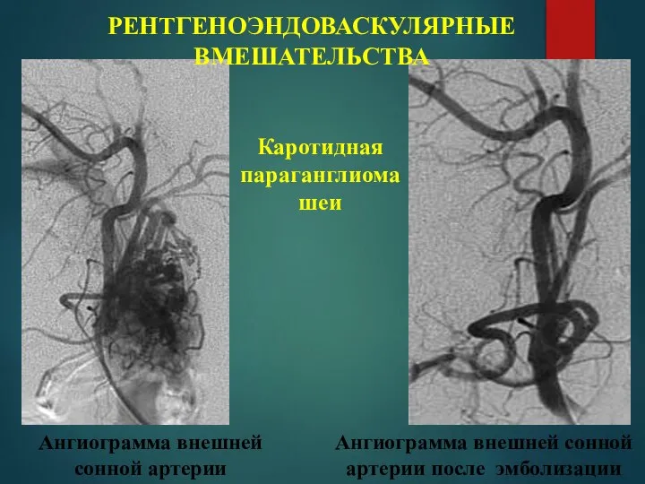 Каротидная параганглиома шеи Ангиограмма внешней сонной артерии Ангиограмма внешней сонной артерии после эмболизации РЕНТГЕНОЭНДОВАСКУЛЯРНЫЕ ВМЕШАТЕЛЬСТВА