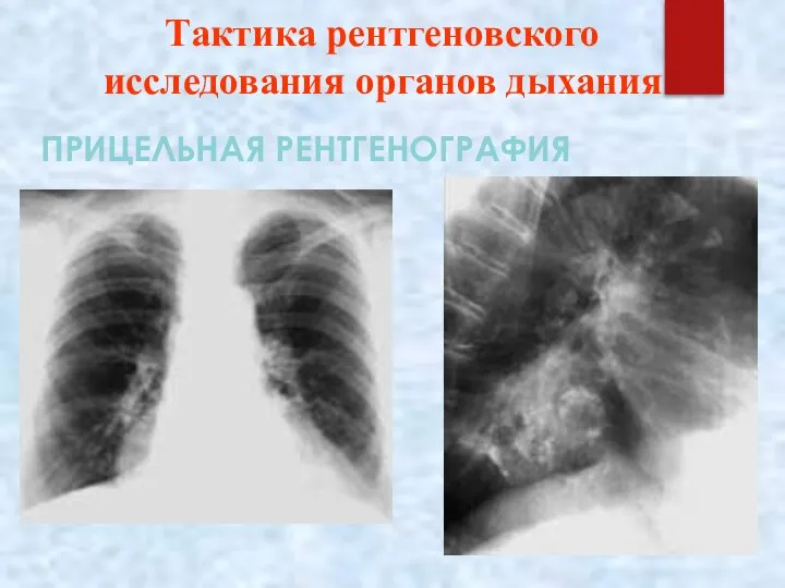 Тактика рентгеновского исследования органов дыхания ПРИЦЕЛЬНАЯ РЕНТГЕНОГРАФИЯ
