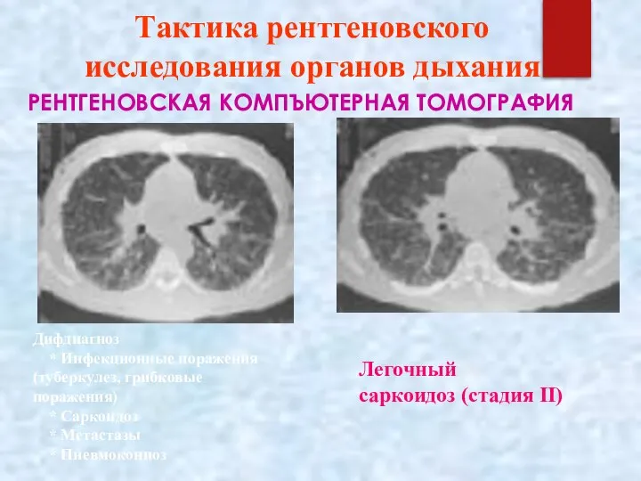 Тактика рентгеновского исследования органов дыхания РЕНТГЕНОВСКАЯ КОМПЪЮТЕРНАЯ ТОМОГРАФИЯ