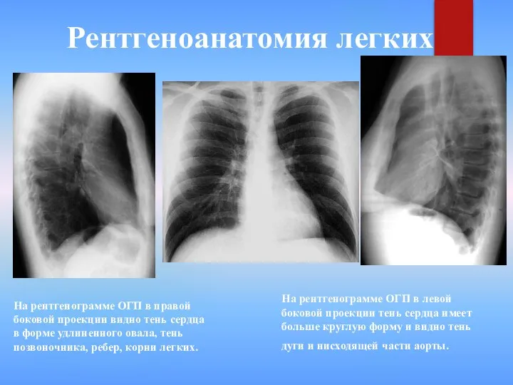 Рентгеноанатомия легких На рентгенограмме ОГП в левой боковой проекции тень сердца