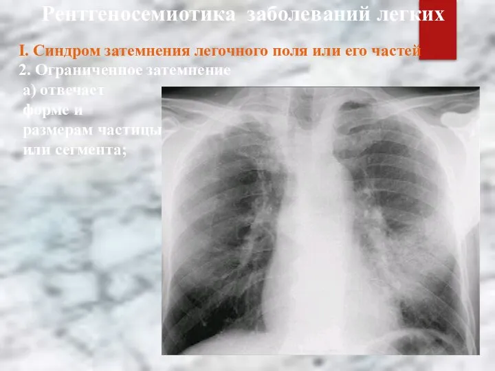 Рентгеносемиотика заболеваний легких
