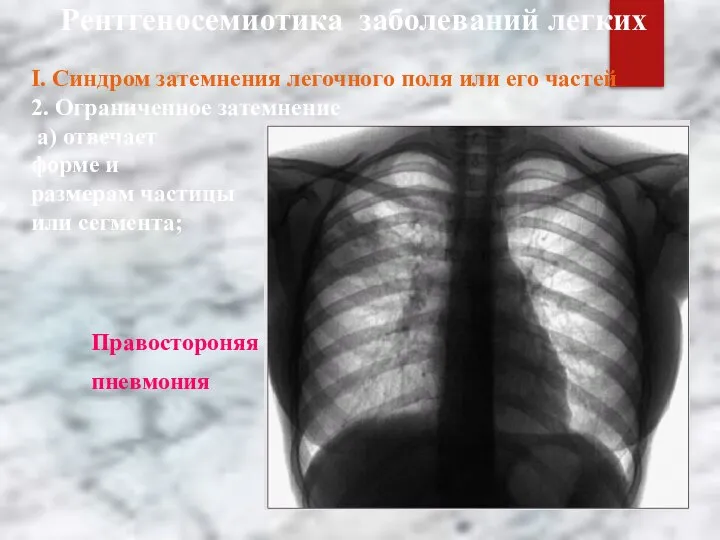 Рентгеносемиотика заболеваний легких І. Синдром затемнения легочного поля или его частей