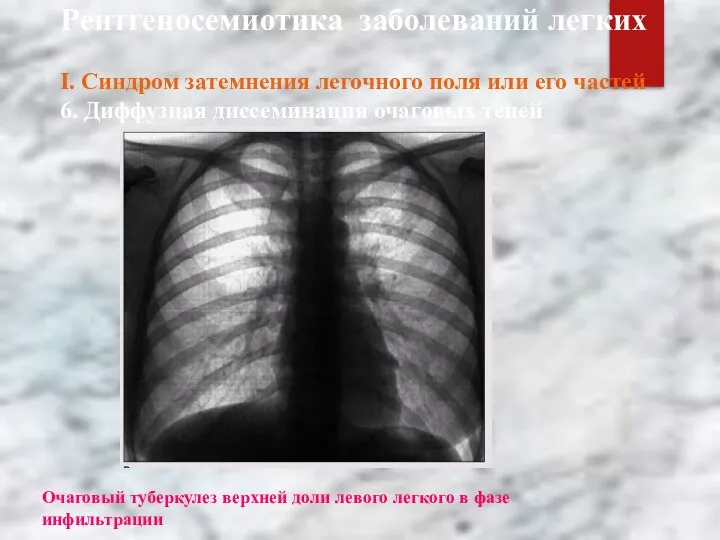 Рентгеносемиотика заболеваний легких І. Синдром затемнения легочного поля или его частей