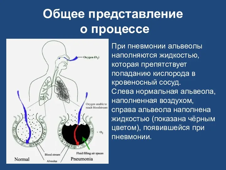 Общее представление о процессе При пневмонии альвеолы наполняются жидкостью, которая препятствует