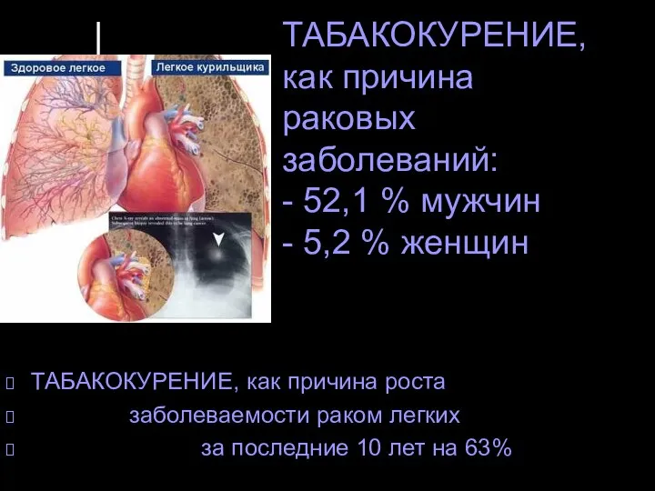 ТАБАКОКУРЕНИЕ, как причина раковых заболеваний: - 52,1 % мужчин - 5,2