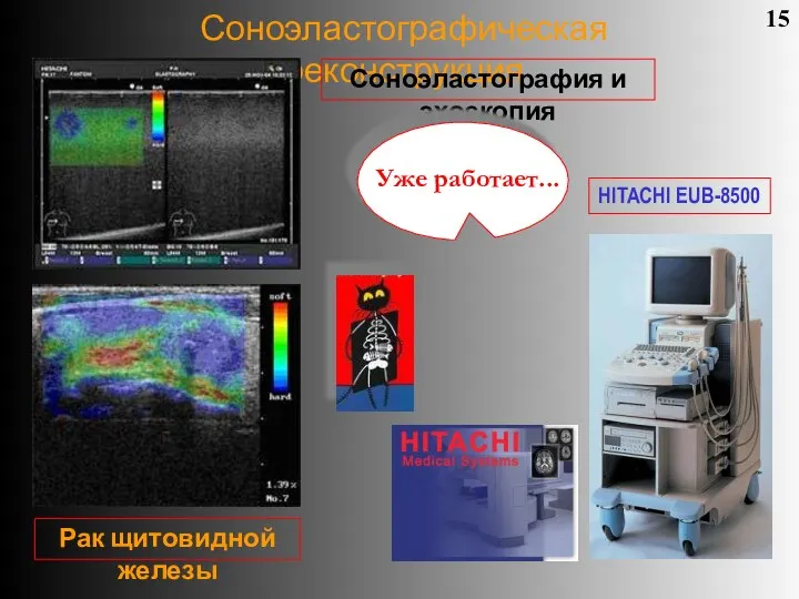 Соноэластографическая реконструкция 15 Соноэластография и эхоскопия Рак щитовидной железы