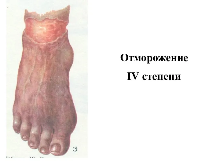 Отморожение IV степени