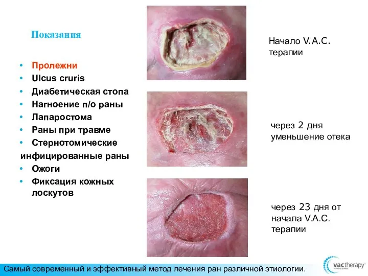 Показания Пролежни Ulcus cruris Диабетическая стопа Нагноение п/о раны Лапаростома Раны