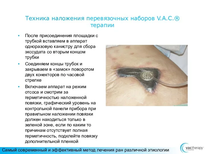 Техника наложения перевязочных наборов V.A.C.® терапии После присоединения площадки с трубкой