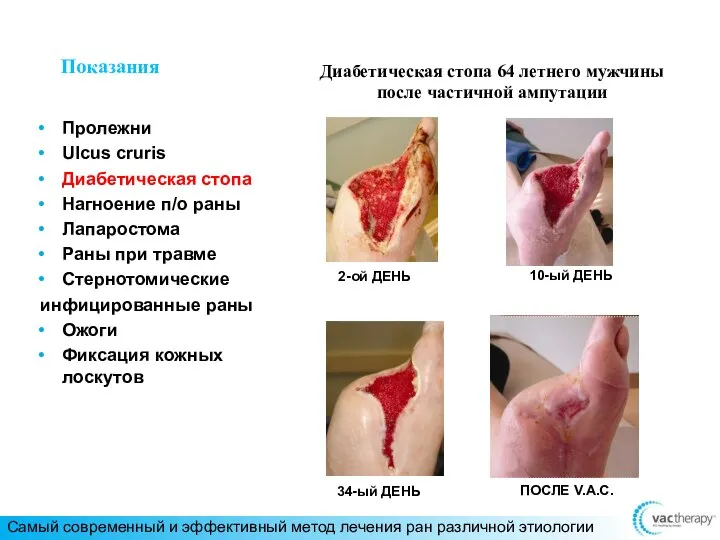 Показания Пролежни Ulcus cruris Диабетическая стопа Нагноение п/о раны Лапаростома Раны