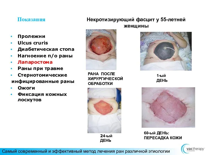 Некротизирующий фасцит у 55-летней женщины Показания Пролежни Ulcus cruris Диабетическая стопа