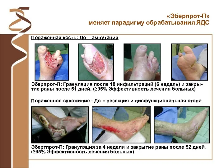 Пораженная кость: До = ампутация Эбертпрот-П: Грануляция за 4 недели и