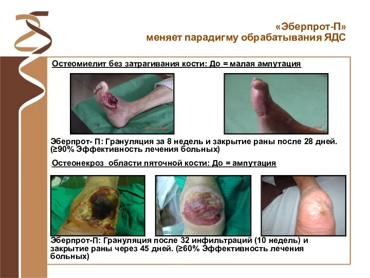 Остеомиелит без затрагивания кости: До = малая ампутация Эберпрот- П: Грануляция