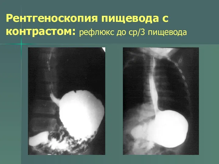 Рентгеноскопия пищевода с контрастом: рефлюкс до ср/3 пищевода