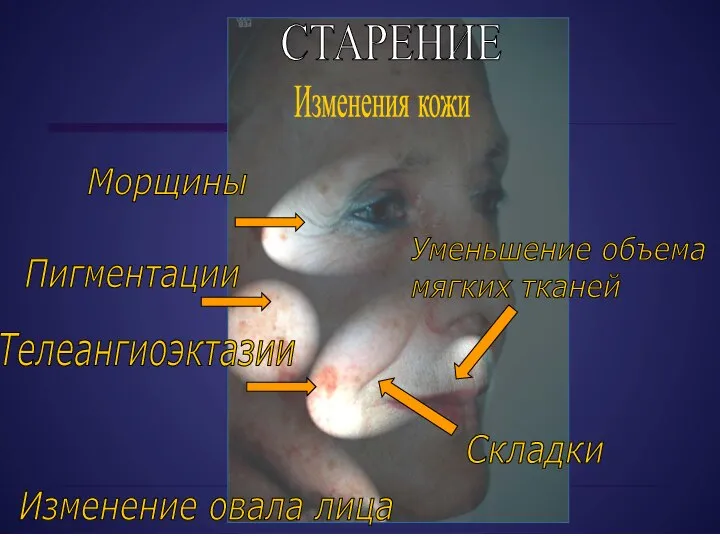 Изменения кожи Пигментации Складки Морщины Телеангиоэктазии Изменение овала лица Уменьшение объема мягких тканей СТАРЕНИЕ