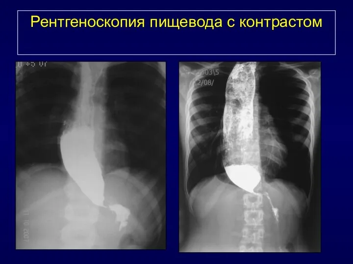 Рентгеноскопия пищевода с контрастом