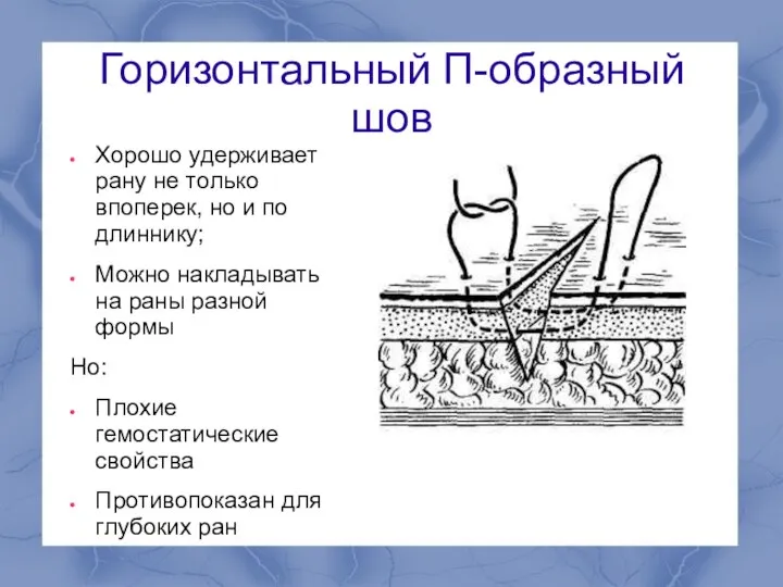 Горизонтальный П-образный шов Хорошо удерживает рану не только впоперек, но и