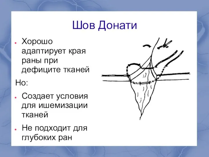 Шов Донати Хорошо адаптирует края раны при дефиците тканей Но: Создает