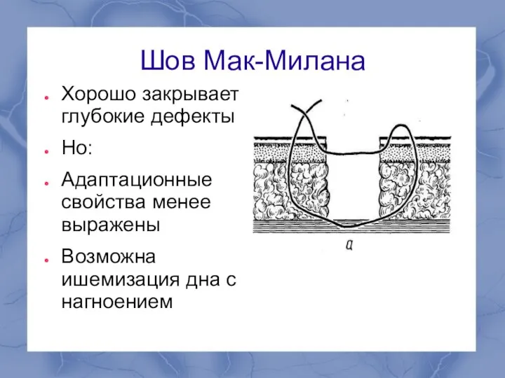 Шов Мак-Милана Хорошо закрывает глубокие дефекты Но: Адаптационные свойства менее выражены Возможна ишемизация дна с нагноением