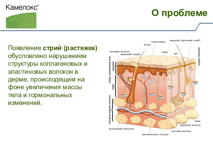 Появление стрий (растяжек) обусловлено нарушением структуры коллагеновых и эластиновых волокон в