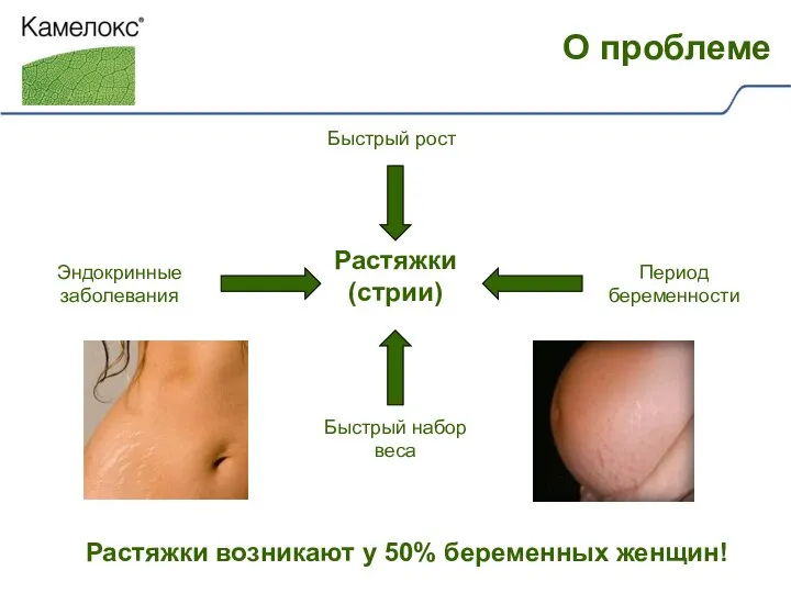 Растяжки возникают у 50% беременных женщин! Растяжки (стрии) Эндокринные заболевания Быстрый