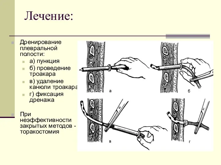 Лечение: Дренирование плевральной полости: а) пункция б) проведение троакара в) удаление