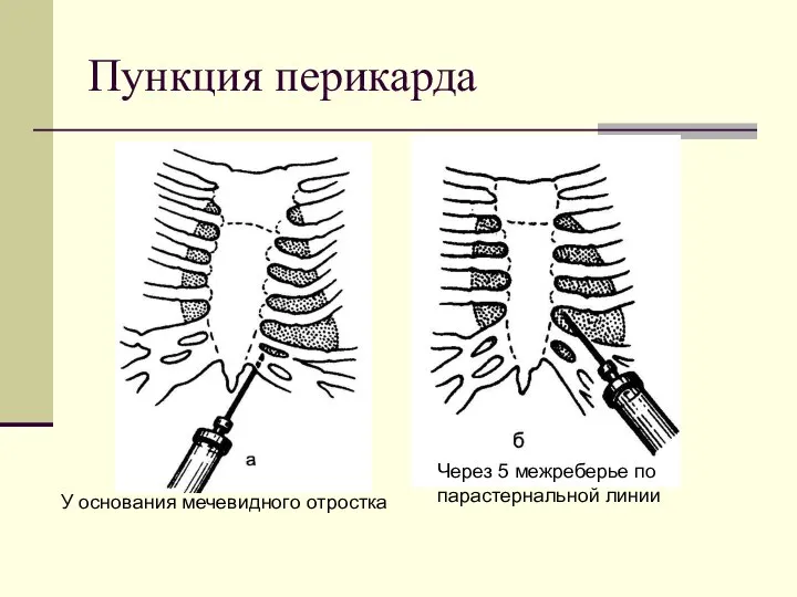 Пункция перикарда У основания мечевидного отростка Через 5 межреберье по парастернальной линии