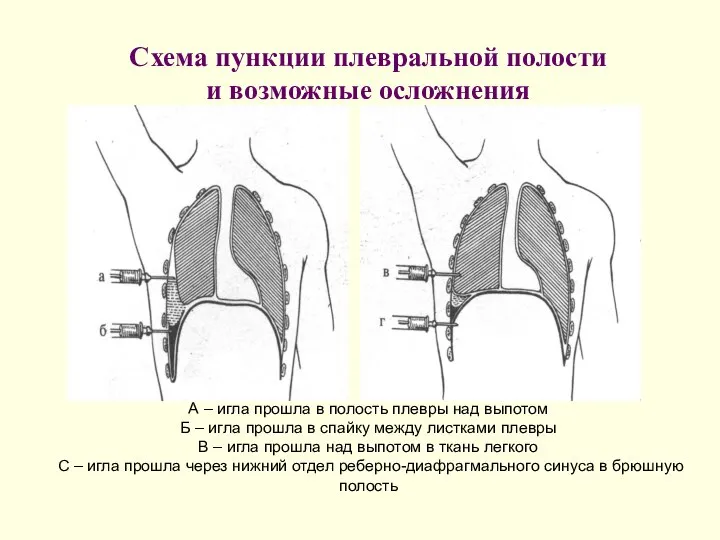 Схема пункции плевральной полости и возможные осложнения А – игла прошла