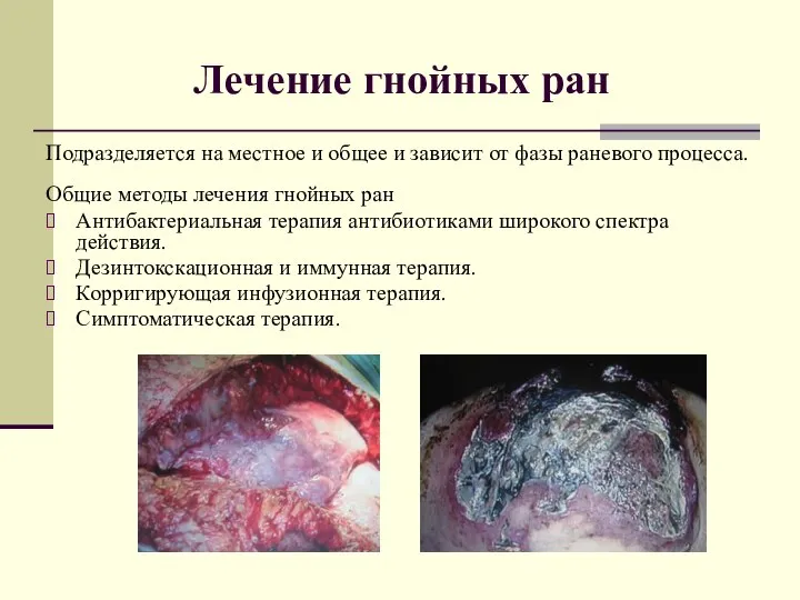 Лечение гнойных ран Подразделяется на местное и общее и зависит от