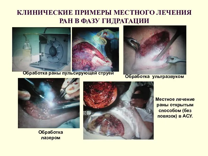 КЛИНИЧЕСКИЕ ПРИМЕРЫ МЕСТНОГО ЛЕЧЕНИЯ РАН В ФАЗУ ГИДРАТАЦИИ Обработка раны пульсирующей