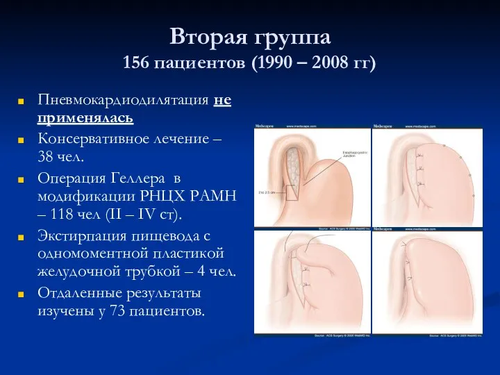 Вторая группа 156 пациентов (1990 – 2008 гг) Пневмокардиодилятация не применялась