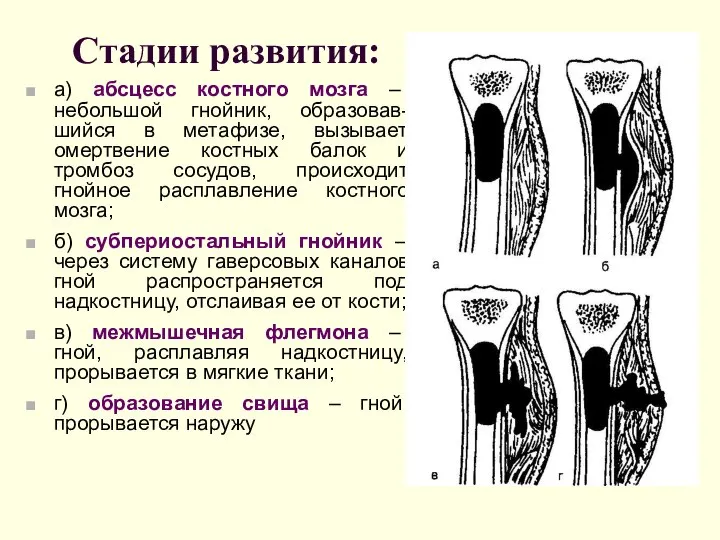 Стадии развития: а) абсцесс костного мозга – небольшой гнойник, образовав-шийся в