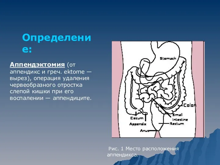 Аппендэктомия (от аппендикс и греч. ektome — вырез), операция удаления червеобразного