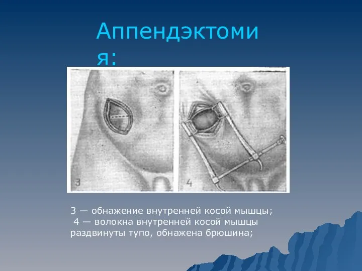 Аппендэктомия: 3 — обнажение внутренней косой мышцы; 4 — волокна внутренней