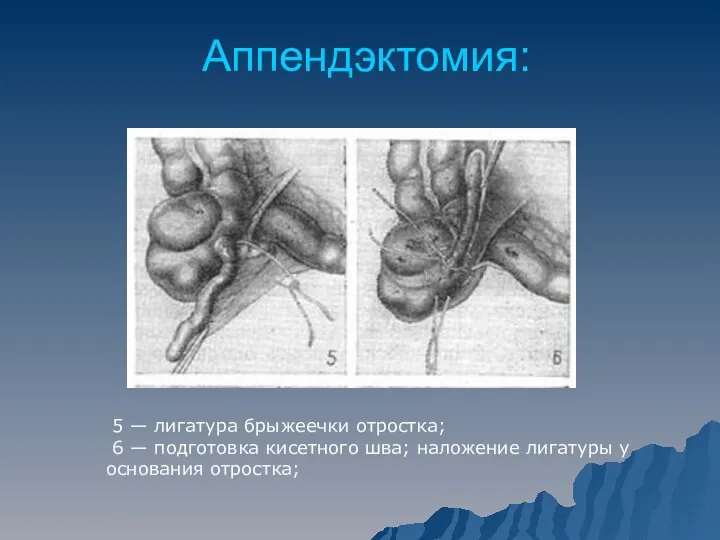 Аппендэктомия: 5 — лигатура брыжеечки отростка; 6 — подготовка кисетного шва; наложение лигатуры у основания отростка;