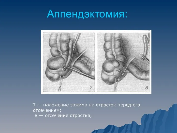 Аппендэктомия: 7 — наложение зажима на отросток перед его отсечением; 8 — отсечение отростка;