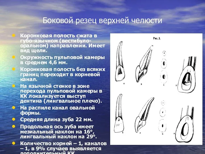 Боковой резец верхней челюсти Коронковая полость сжата в губо-язычном (вестибуло-оральном) направлении.