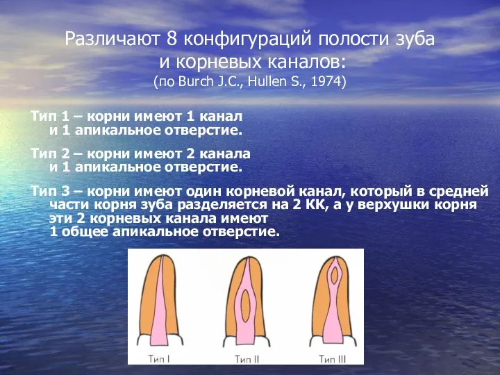 Различают 8 конфигураций полости зуба и корневых каналов: (по Burch J.C.,