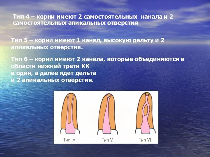 Тип 4 – корни имеют 2 самостоятельных канала и 2 самостоятельных