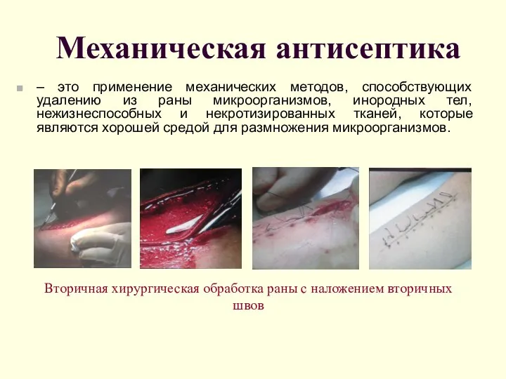 Механическая антисептика – это применение механических методов, способствующих удалению из раны
