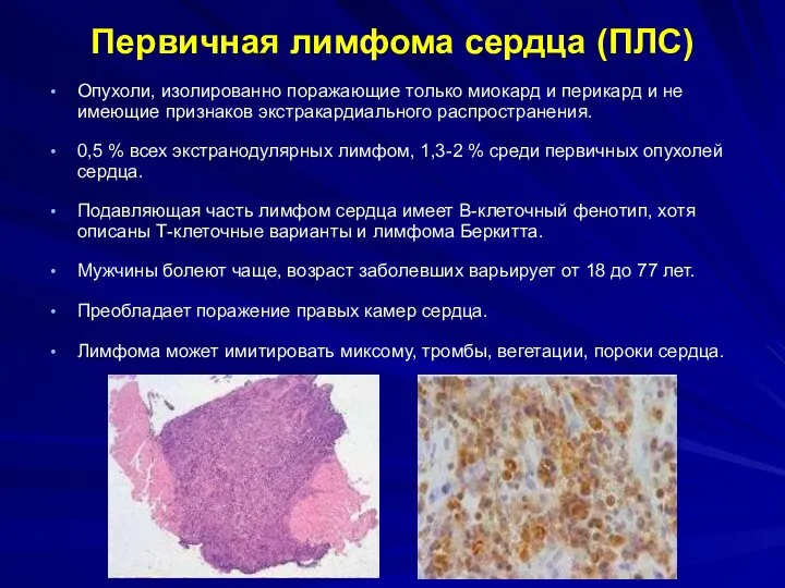 Опухоли, изолированно поражающие только миокард и перикард и не имеющие признаков