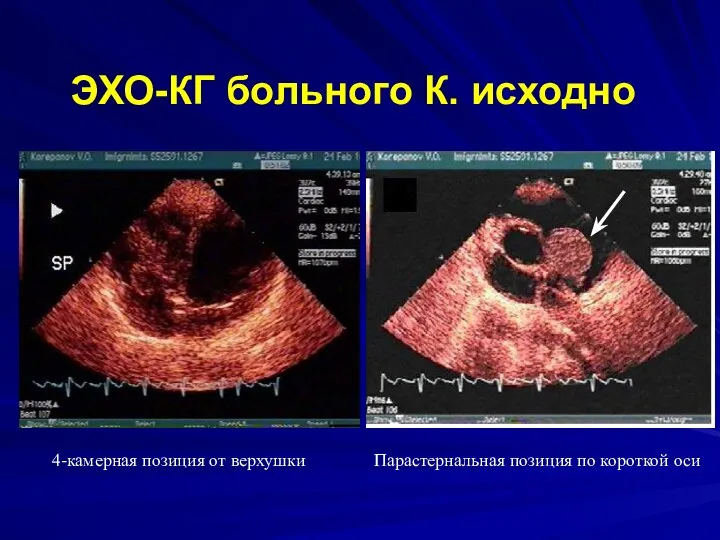 ЭХО-КГ больного К. исходно 4-камерная позиция от верхушки Парастернальная позиция по короткой оси