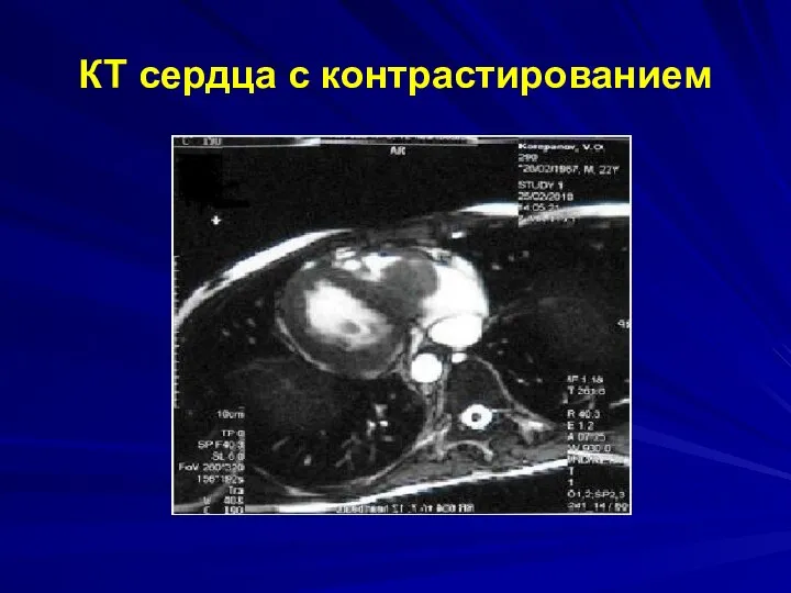 КТ сердца с контрастированием